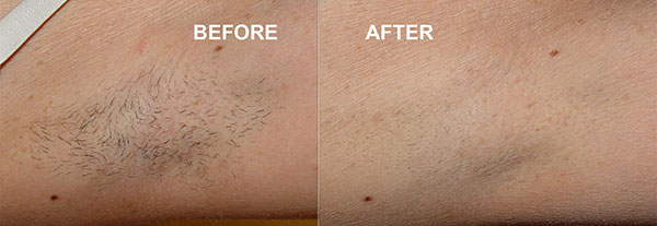 hair removal lafayette