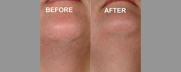 hair removal lafayette